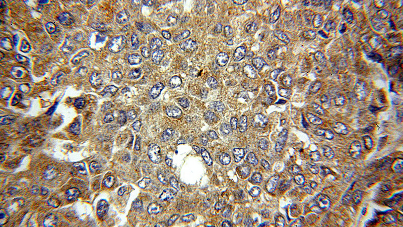 Immunohistochemical of paraffin-embedded human liver cancer using Catalog No:112699(MMP19 antibody) at dilution of 1:50 (under 40x lens)