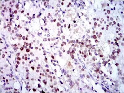 Immunohistochemical analysis of paraffin-embedded cervical cancer tissues using CDK2 mouse mAb with DAB staining.