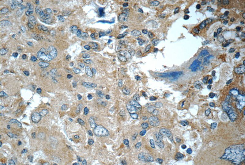 Immunohistochemistry of paraffin-embedded human gliomas tissue slide using Catalog No:108802(C9orf72 Antibody) at dilution of 1:50 (under 40x lens)