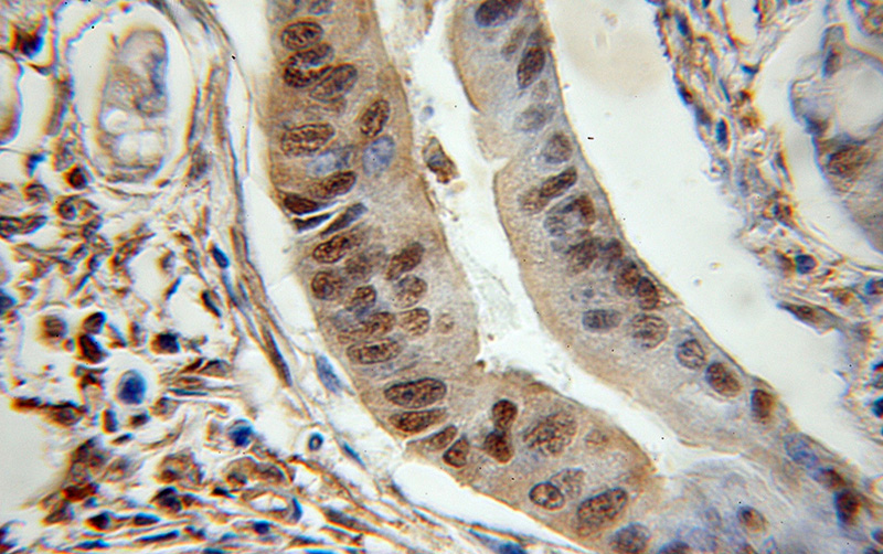 Immunohistochemical of paraffin-embedded human colon cancer using Catalog No:110253(ENO1 antibody) at dilution of 1:50 (under 10x lens)