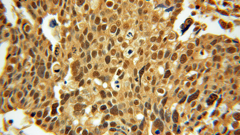 Immunohistochemical of paraffin-embedded human ovary tumor using Catalog No:113830(phospho-CHC1(Ser12) antibody) at dilution of 1:50 (under 40x lens)