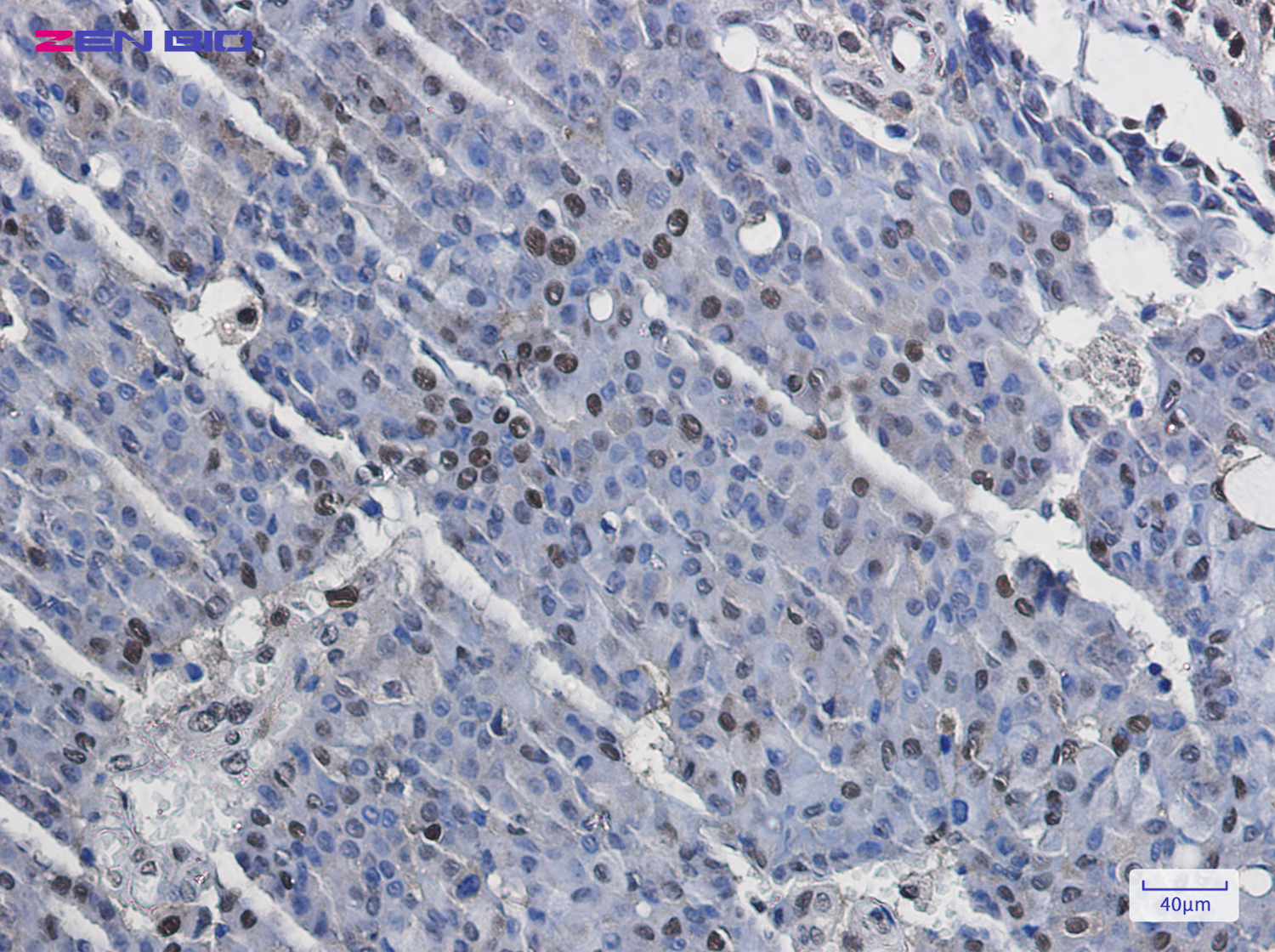 Immunohistochemistry of MSK1 (Phospho-Ser376) in paraffin-embedded Human breast cancer tissue using MSK1 (Phospho-Ser376) Rabbit pAb at dilution 1/20