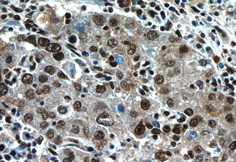 Immunohistochemistry of paraffin-embedded human liver cancer tissue slide using Catalog No:113157(NFKB2 Antibody) at dilution of 1:50 (under 40x lens)