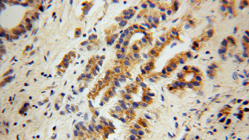 Immunohistochemical of paraffin-embedded human gliomas using Catalog No:114571(RCAN2 antibody) at dilution of 1:100 (under 40x lens)