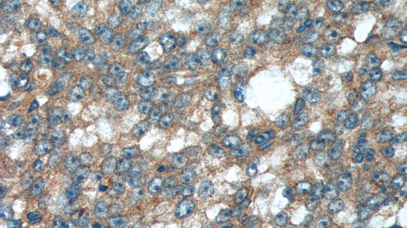 Immunohistochemistry of paraffin-embedded human prostate cancer tissue slide using Catalog No:107357(JNK Antibody) at dilution of 1:200 (under 40x lens).
