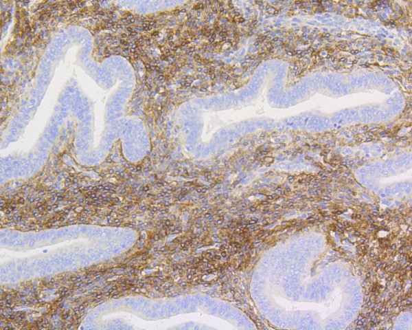 Fig6:; Immunohistochemical analysis of paraffin-embedded human uterus tissue using anti-p75 NGF Receptor antibody. The section was pre-treated using heat mediated antigen retrieval with Tris-EDTA buffer (pH 8.0-8.4) for 20 minutes.The tissues were blocked in 5% BSA for 30 minutes at room temperature, washed with ddH; 2; O and PBS, and then probed with the primary antibody ( 1/50) for 30 minutes at room temperature. The detection was performed using an HRP conjugated compact polymer system. DAB was used as the chromogen. Tissues were counterstained with hematoxylin and mounted with DPX.