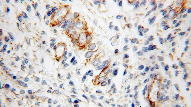 Immunohistochemical of paraffin-embedded human endometrial cancer using Catalog No:108772(CDH13 antibody) at dilution of 1:100 (under 10x lens)