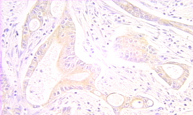 Immunohistochemical of paraffin-embedded human colon cancer using Catalog No:114528(CRADD antibody) at dilution of 1:100 (under 25x lens)