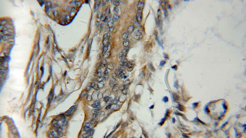 Immunohistochemical of paraffin-embedded human pancreas cancer using Catalog No:113227(NQO1 antibody) at dilution of 1:50 (under 10x lens)