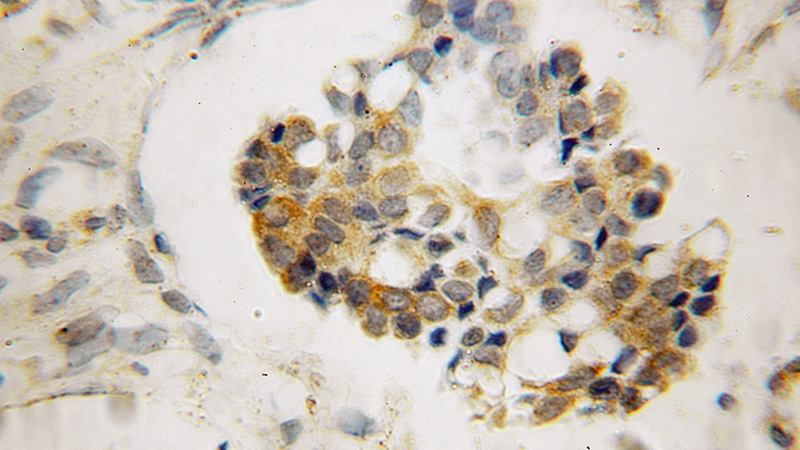 Immunohistochemical of paraffin-embedded human ovary tumor using Catalog No:113535(CDKN2B antibody) at dilution of 1:100 (under 25x lens)