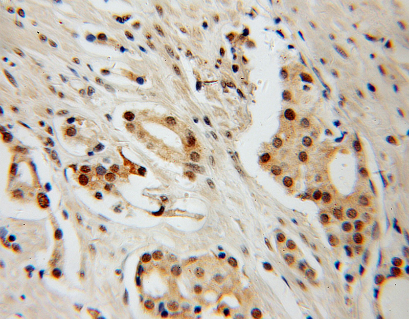 Immunohistochemical of paraffin-embedded human prostate cancer using Catalog No:111373(HDAC2 antibody) at dilution of 1:100 (under 10x lens)