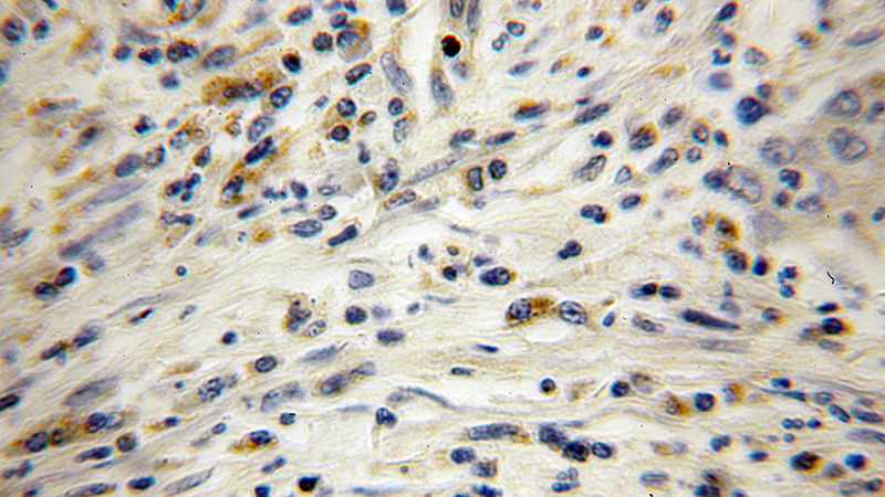 Immunohistochemical of paraffin-embedded human colon cancer using Catalog No:116332(TAGLN2 antibody) at dilution of 1:100 (under 10x lens)