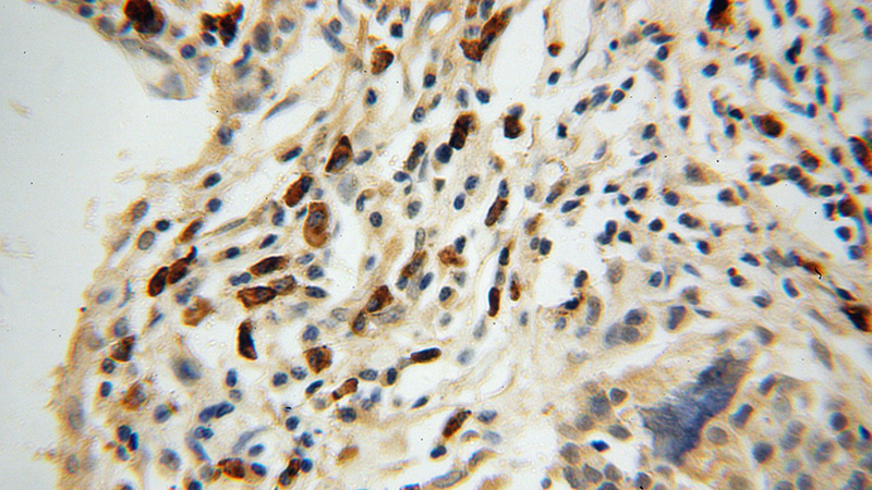 Immunohistochemical of paraffin-embedded human ovary tumor using Catalog No:107854(AIG1 antibody) at dilution of 1:100 (under 40x lens)