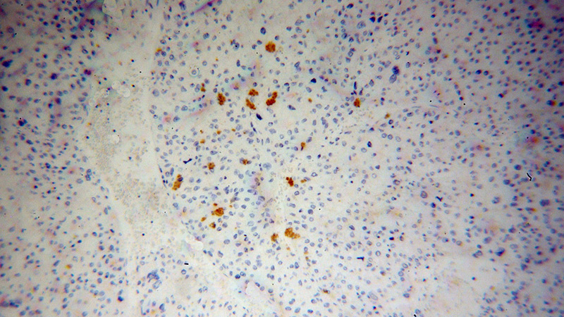 Immunohistochemical of paraffin-embedded human liver cancer using Catalog No:108057(ANGPTL3 antibody) at dilution of 1:100 (under 10x lens)