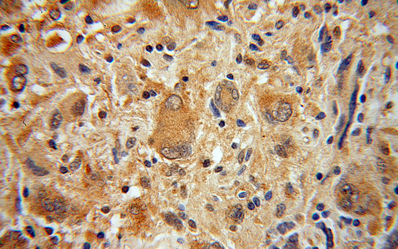 Immunohistochemical of paraffin-embedded human gliomas using Catalog No:113198(CDKL3 antibody) at dilution of 1:50 (under 40x lens)