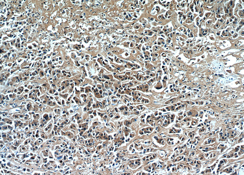 Immunohistochemical of paraffin-embedded human breast cancer using Catalog No:114748(RNF170 antibody) at dilution of 1:50 (under 10x lens)