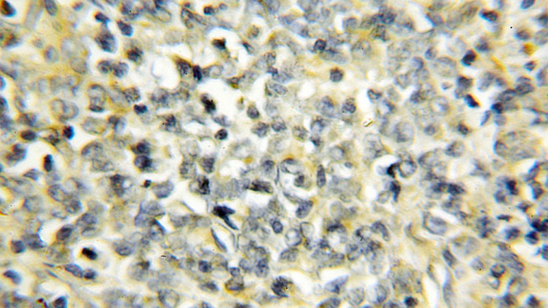Immunohistochemical of paraffin-embedded human lymphoma using Catalog No:113190(NIPSNAP3B antibody) at dilution of 1:50 (under 10x lens)