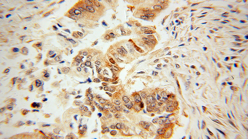 Immunohistochemical of paraffin-embedded human pancreas cancer using Catalog No:111681(IGF2BP3 antibody) at dilution of 1:100 (under 40x lens)