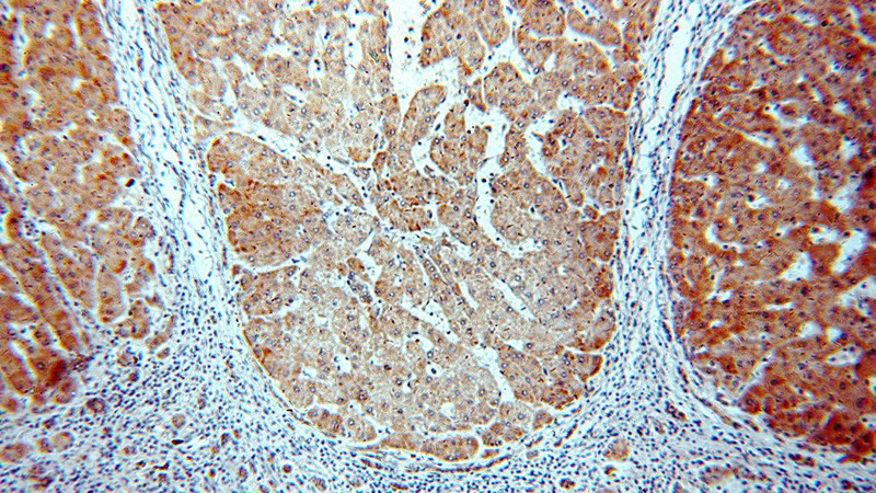 Immunohistochemical of paraffin-embedded human hepatocirrhosis using Catalog No:109688(CYP26B1 antibody) at dilution of 1:50 (under 10x lens)