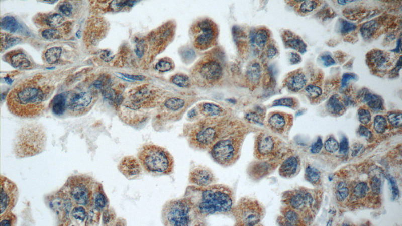 Immunohistochemistry of paraffin-embedded human lung cancer slide using Catalog No:116287(TNFAIP8 Antibody) at dilution of 1:50