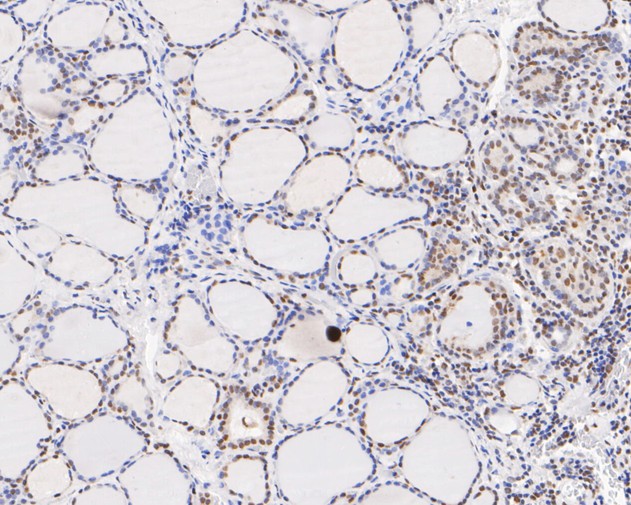 Fig3:; Immunohistochemical analysis of paraffin-embedded human thyroid tissue using anti-GATAD2A antibody. The section was pre-treated using heat mediated antigen retrieval with sodium citrate buffer (pH 6.0) for 20 minutes. The tissues were blocked in 5% BSA for 30 minutes at room temperature, washed with ddH; 2; O and PBS, and then probed with the primary antibody ( 1/200) for 30 minutes at room temperature. The detection was performed using an HRP conjugated compact polymer system. DAB was used as the chromogen. Tissues were counterstained with hematoxylin and mounted with DPX.