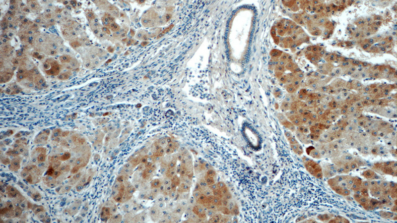 Immunohistochemistry of paraffin-embedded human hepatocirrhosis tissue slide using Catalog No:116587(USP11 Antibody) at dilution of 1:50 (under 10x lens)