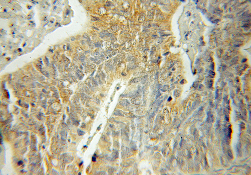 Immunohistochemical of paraffin-embedded human ovary tumor using Catalog No:115190(SH3BP5 antibody) at dilution of 1:50 (under 10x lens)