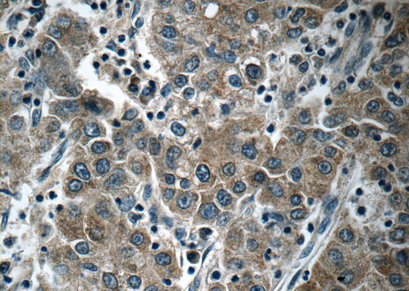 Immunohistochemistry of paraffin-embedded human liver cancer tissue slide using Catalog No:112043(FAM30A Antibody) at dilution of 1:50 (under 40x lens)