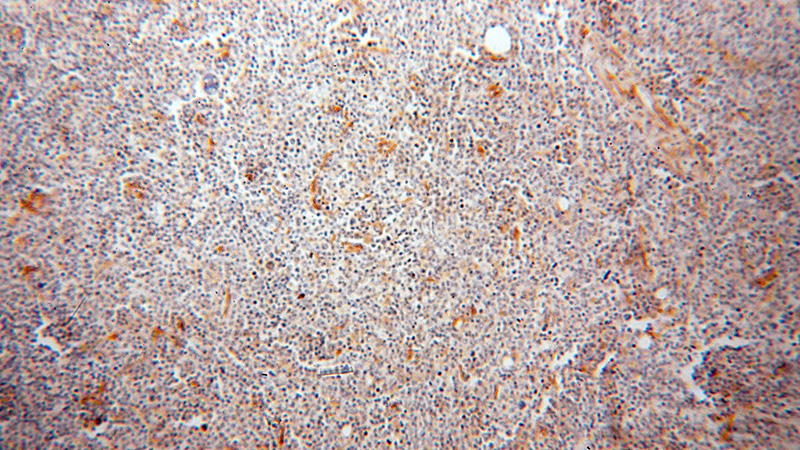 Immunohistochemical of paraffin-embedded human lymphoma using Catalog No:108420(BCAP29 antibody) at dilution of 1:200 (under 10x lens)