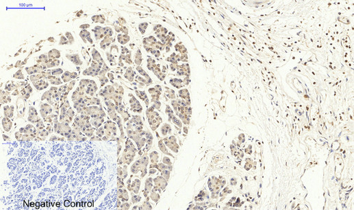 Immunohistochemical analysis of paraffin-embedded Human-stomach-cancer tissue. 1,Lamin B1 Polyclonal Antibody was diluted at 1:200(4°C,overnight). 2, Sodium citrate pH 6.0 was used for antibody retrieval(>98°C,20min). 3,Secondary antibody was diluted at 1:200(room tempeRature, 30min). Negative control was used by secondary antibody only.