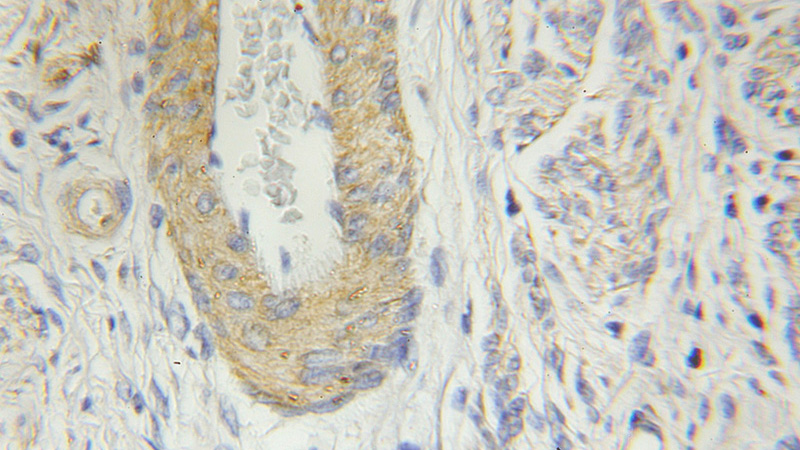 Immunohistochemical of paraffin-embedded human cervical cancer using Catalog No:109539(CRBN antibody) at dilution of 1:50 (under 10x lens)