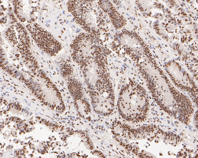 Fig4:; Immunohistochemical analysis of paraffin-embedded human colon carcinoma tissue using anti-GATAD2A antibody. The section was pre-treated using heat mediated antigen retrieval with sodium citrate buffer (pH 6.0) for 20 minutes. The tissues were blocked in 5% BSA for 30 minutes at room temperature, washed with ddH; 2; O and PBS, and then probed with the primary antibody ( 1/200) for 30 minutes at room temperature. The detection was performed using an HRP conjugated compact polymer system. DAB was used as the chromogen. Tissues were counterstained with hematoxylin and mounted with DPX.