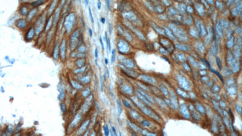 Immunohistochemistry of paraffin-embedded human colon cancer tissue slide using Catalog No:114307(PTK7 Antibody) at dilution of 1:200 (under 40x lens). heat mediated antigen retrieved with Tris-EDTA buffer(pH9).