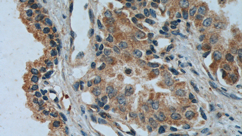 Immunohistochemistry of paraffin-embedded human prostate cancer tissue slide using Catalog No:109662(Cyclin B1 Antibody) at dilution of 1:50 (under 40x lens). heat mediated antigen retrieved with Tris-EDTA buffer(pH9).