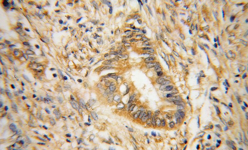 Immunohistochemical of paraffin-embedded human colon cancer using Catalog No:114832(RPS19 antibody) at dilution of 1:100 (under 40x lens)