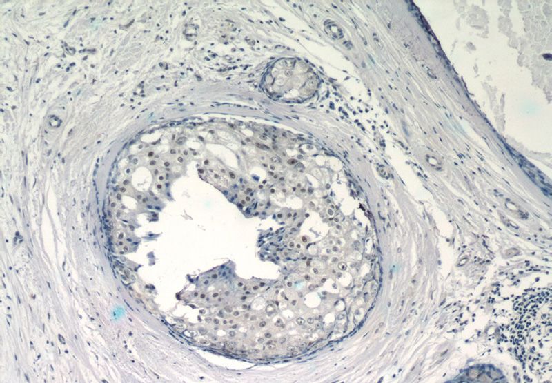 Immunohistochemistry of paraffin-embedded human breast cancer tissue slide using Catalog No:110170(EID1 Antibody) at dilution of 1:50 (under 10x lens)