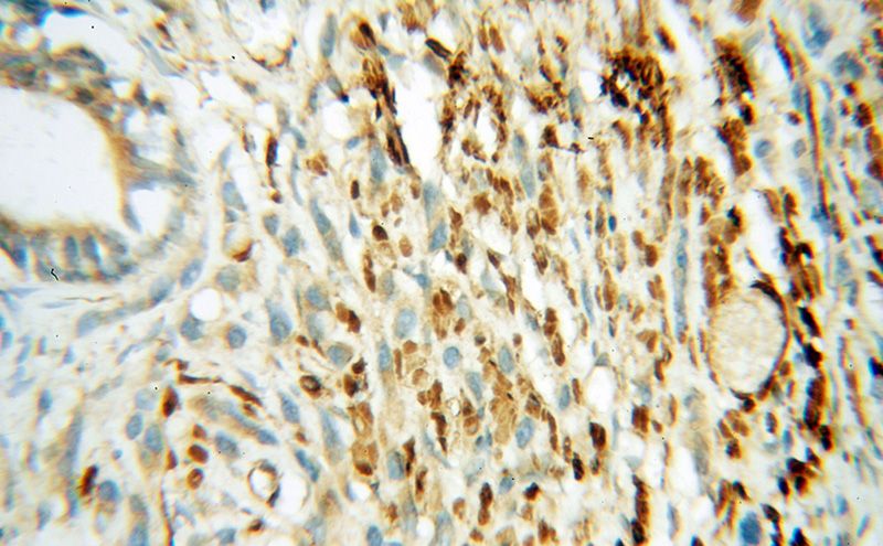 Immunohistochemical of paraffin-embedded human prostate cancer using Catalog No:111171(GSK3B antibody) at dilution of 1:100 (under 40x lens)