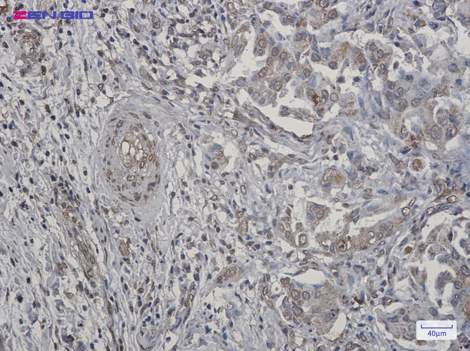 Immunohistochemistry of TNFAIP3 in paraffin-embedded Human lung cancer tissue using TNFAIP3 Rabbit pAb at dilution 1/20