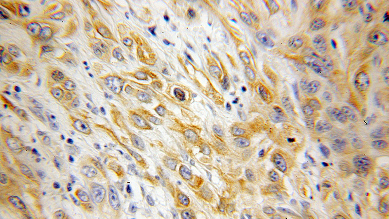 Immunohistochemical of paraffin-embedded human cervical cancer using Catalog No:113794(PGRMC1 antibody) at dilution of 1:100 (under 10x lens)