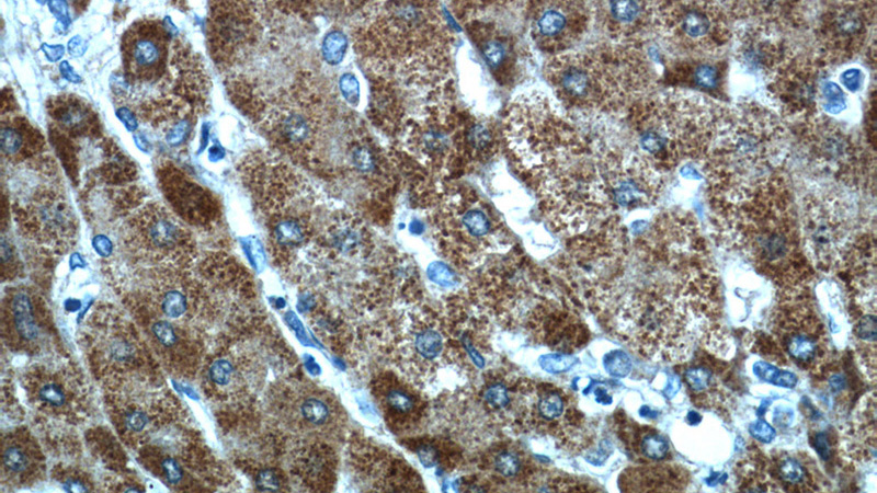 Immunohistochemistry of paraffin-embedded human hepatocirrhosis tissue slide using Catalog No:111949(ITIH4 Antibody) at dilution of 1:50 (under 40x lens)