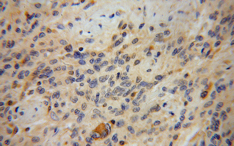Immunohistochemical of paraffin-embedded human gliomas using Catalog No:116210(TPP2 antibody) at dilution of 1:100 (under 40x lens)
