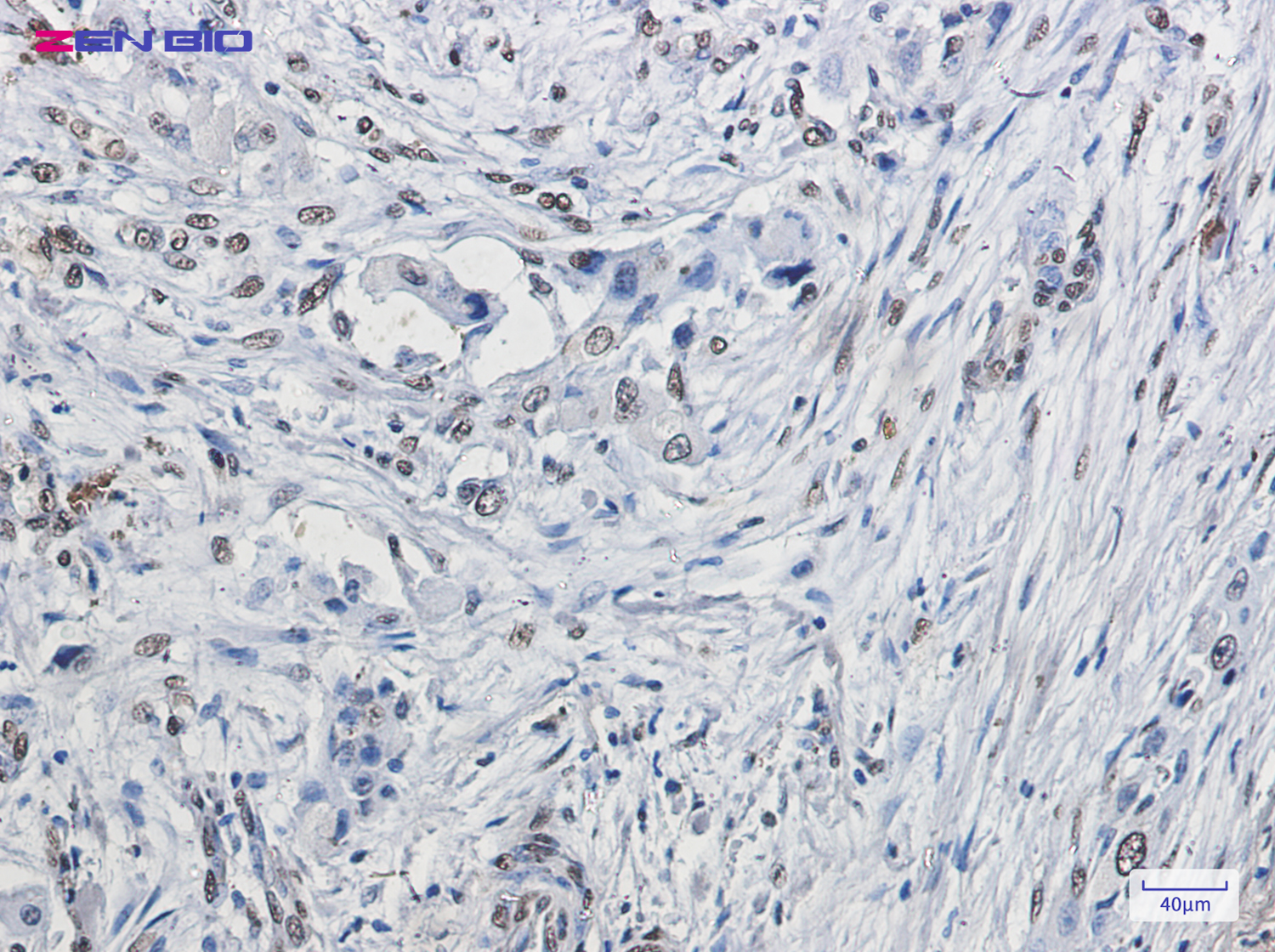 Immunohistochemistry of ELK1 in paraffin-embedded Human lung cancer tissue using ELK1 Rabbit pAb at dilution 1/20