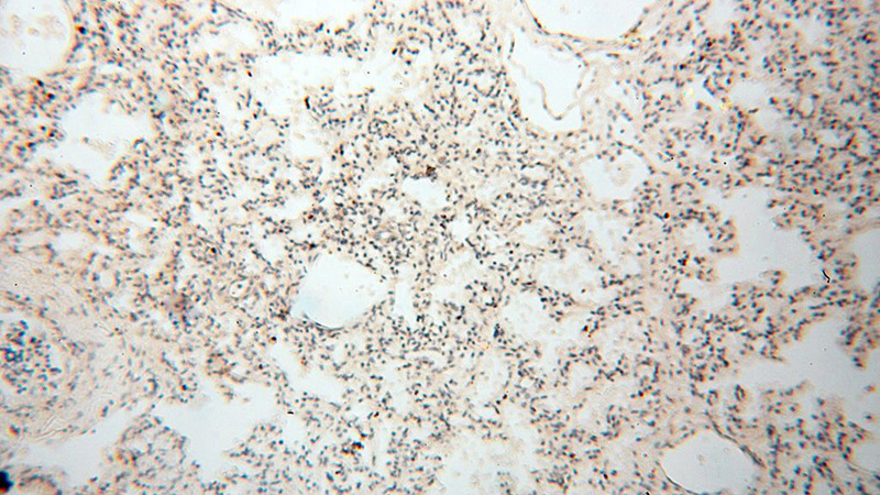 Immunohistochemical of paraffin-embedded human lung using Catalog No:111095(CSF2 antibody) at dilution of 1:100 (under 10x lens)
