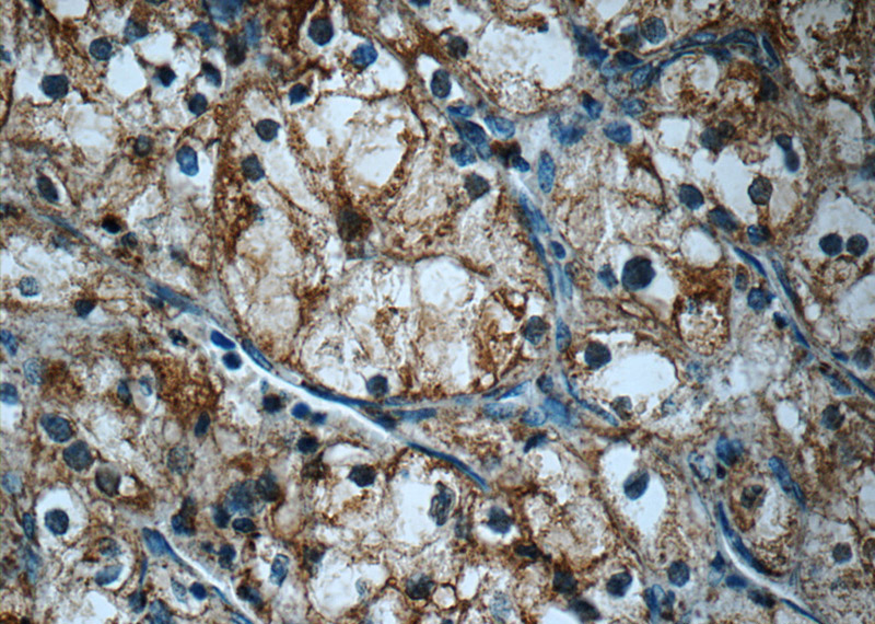Immunohistochemistry of paraffin-embedded human renal cell carcinoma tissue slide using Catalog No:110510(FAM92A1 Antibody) at dilution of 1:50 (under 40x lens)