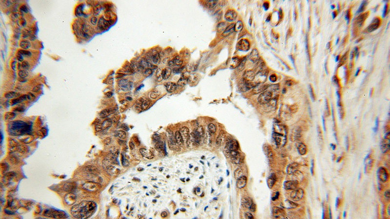 Immunohistochemical of paraffin-embedded human ovary tumor using Catalog No:114265(PTER antibody) at dilution of 1:50 (under 10x lens)