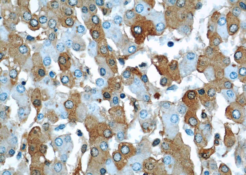 Immunohistochemical of paraffin-embedded human liver using Catalog No:107569(ALB antibody) at dilution of 1:50 (under 40x lens)