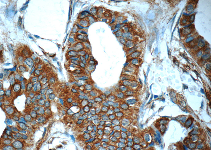 Immunohistochemistry of paraffin-embedded human breast cancer tissue slide using Catalog No:112462(SCGB2A2 Antibody) at dilution of 1:50 (under 40x lens)