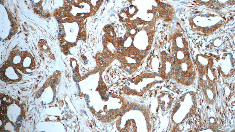 Immunohistochemistry of paraffin-embedded human breast cancer tissue slide using Catalog No:108252(ARFGAP3 Antibody) at dilution of 1:50 (under 10x lens)