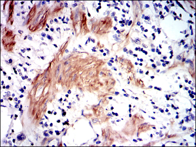 Immunohistochemical analysis of paraffin-embedded stomach cancer tissues using GSTM1 mouse mAb with DAB staining.