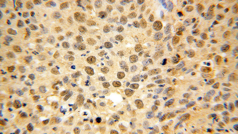 Immunohistochemical of paraffin-embedded human cervical cancer using Catalog No:116585(USP1 antibody) at dilution of 1:100 (under 40x lens)